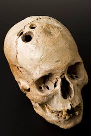 Trepanned skull